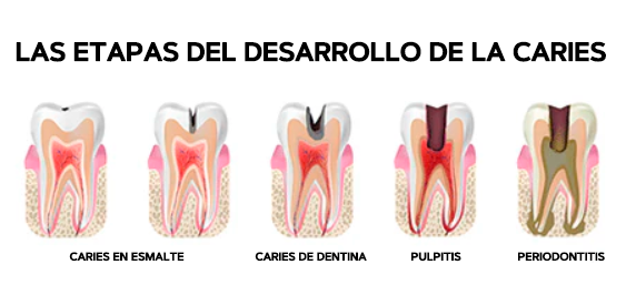 1 + 1 GRATIS | Blanqueador de dientes - TeethWhitenerPro™