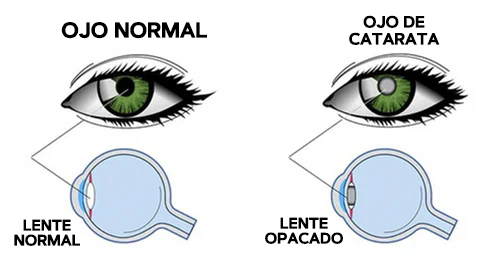 Cataratas Glaucoma Gotas Lubricantes para Ojos - CataractsGlaucomaEyeDrops™