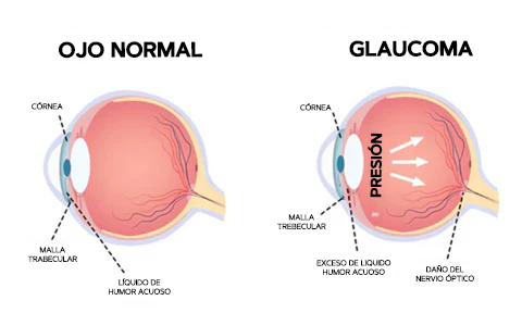 Cataratas Glaucoma Gotas Lubricantes para Ojos - CataractsGlaucomaEyeDrops™