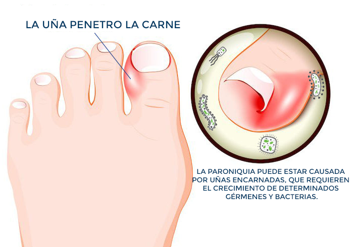 Aceite para el cuidado de pies y manos - NailCare™