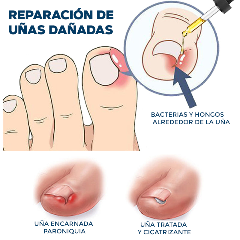 Aceite para el cuidado de pies y manos - NailCare™